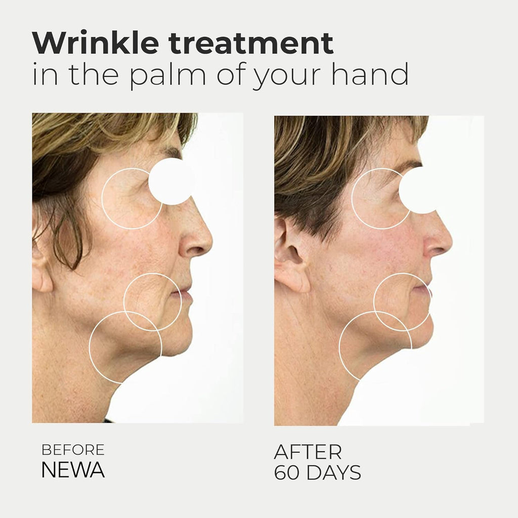 RF Wrinkle Reduction & Facial Tightening Device