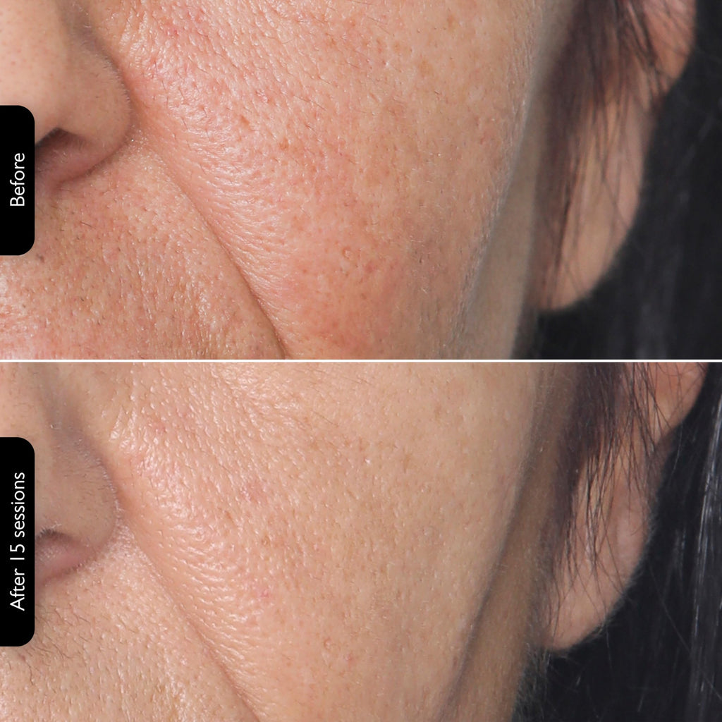3-in-1 RF Skin Tightening Device with Red Light & Laser