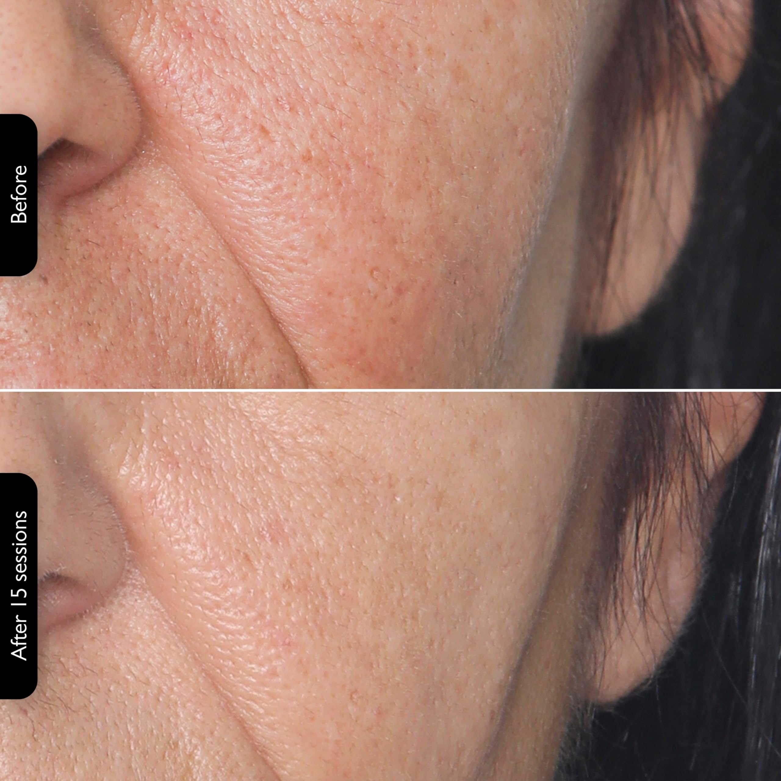 3-in-1 RF Skin Tightening Device with Red Light & Laser