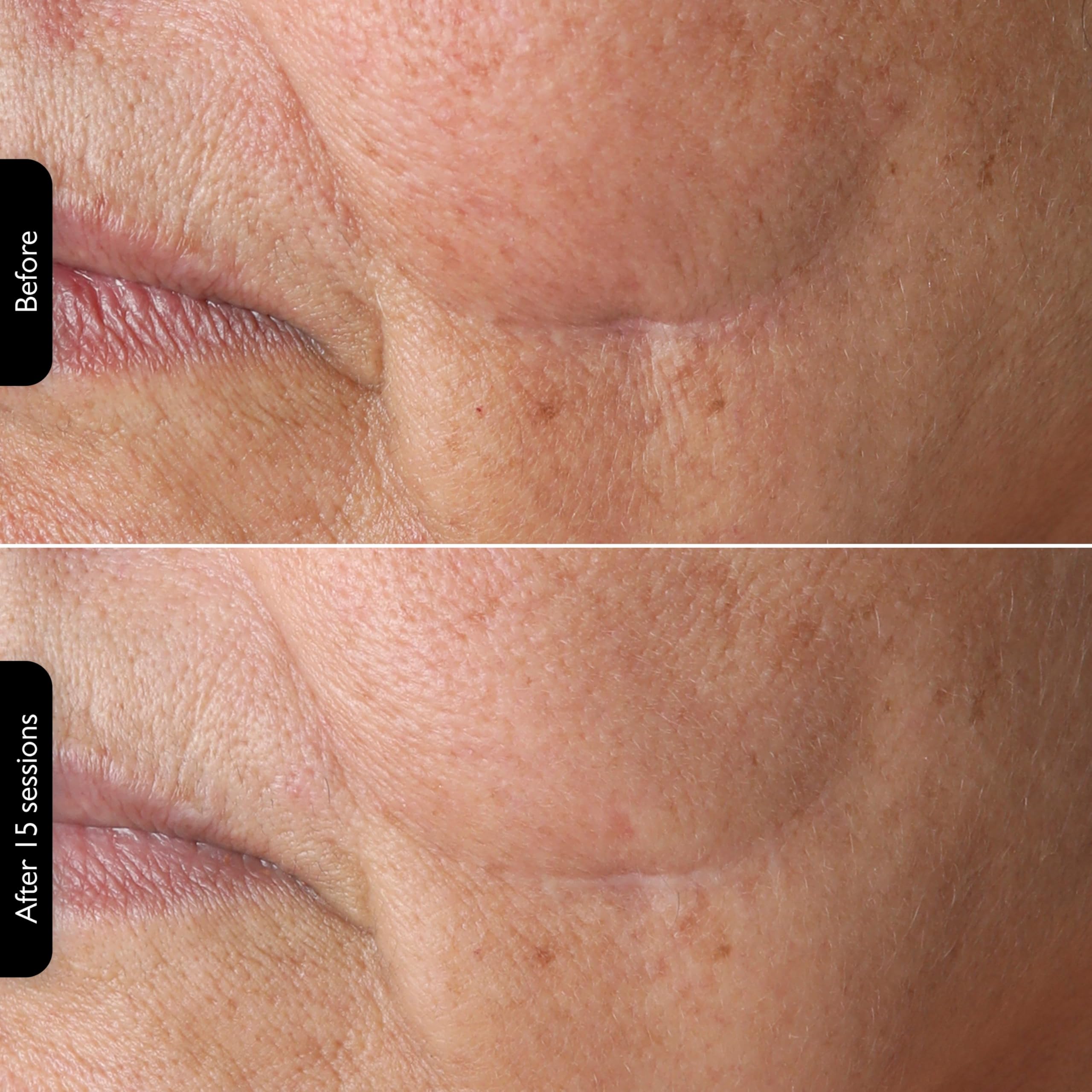 3-in-1 RF Skin Tightening Device with Red Light & Laser