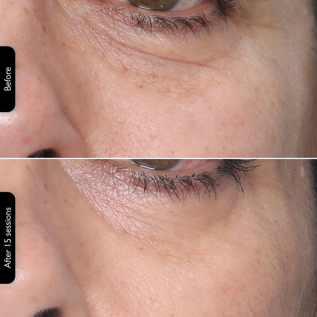 3-in-1 RF Skin Tightening Device with Red Light & Laser