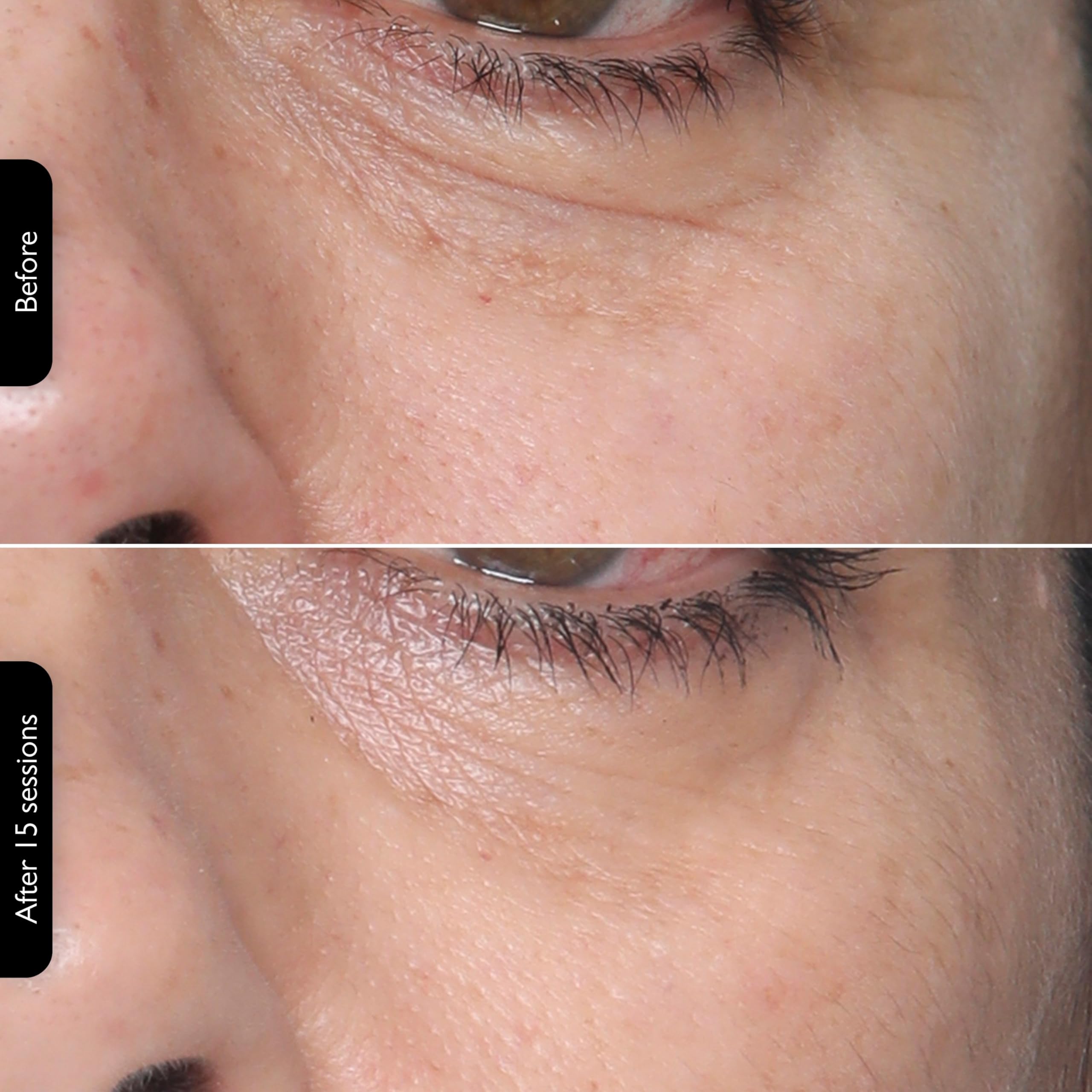 3-in-1 RF Skin Tightening Device with Red Light & Laser