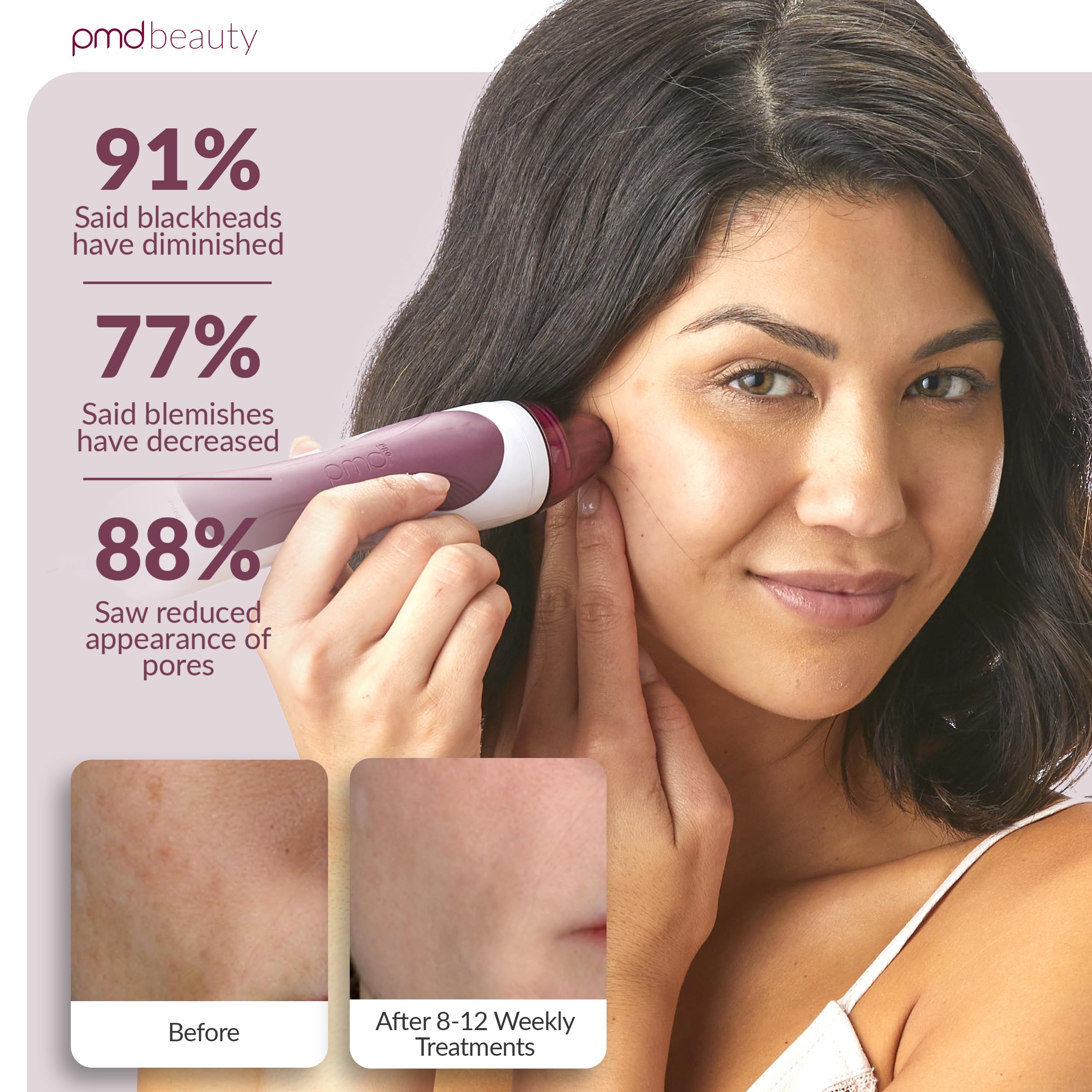 Pro Microdermabrasion Face & Body Exfoliation Device